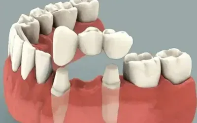 Bridges_and_Crowns