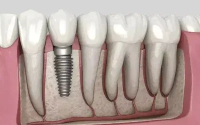Dental_Implants_1