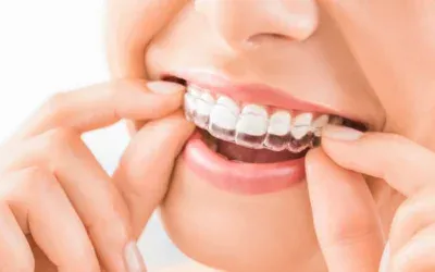 Invisalign_1
